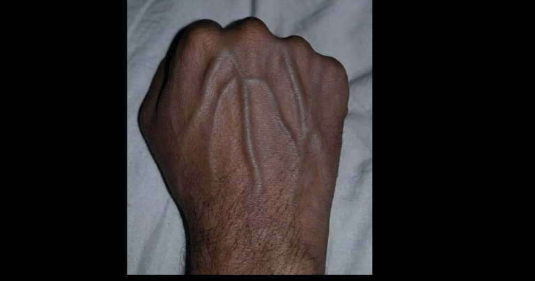 Are Those Visible Veins A Secret Warning Sign Of A Deadly Health Crisis
