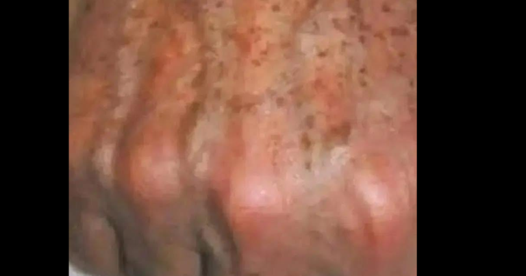 Did you know that if you get SPOTS on your HANDS it is a sign that you suffer from